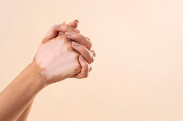 Vitiligo hand
